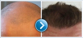 hair transplant clinic